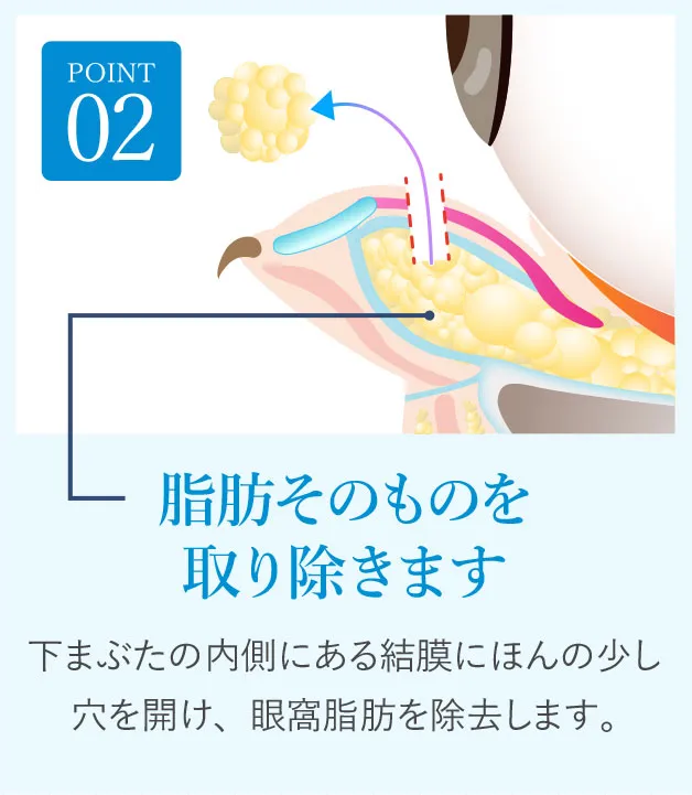 POINT02 脂肪そのものを取り除きます