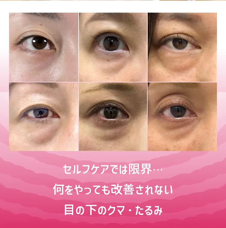 セルフケアでは限界…何をやっても改善されない目の下のクマ・たるみ