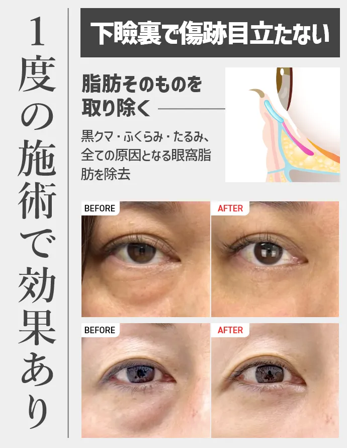 一度の施術で効果あり