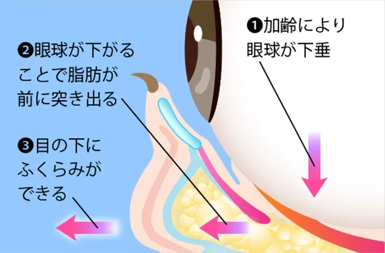 切らない目の下のクマ取りの記事