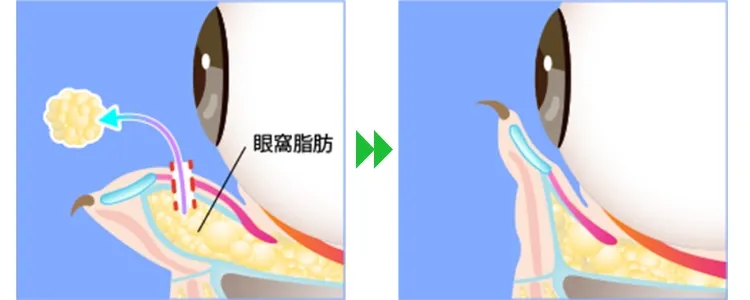 切らない目の下のクマ取りの記事