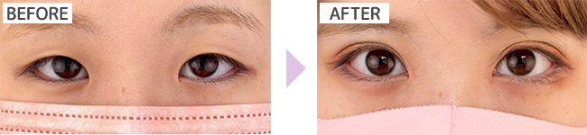 TCB式目頭・目尻切開術