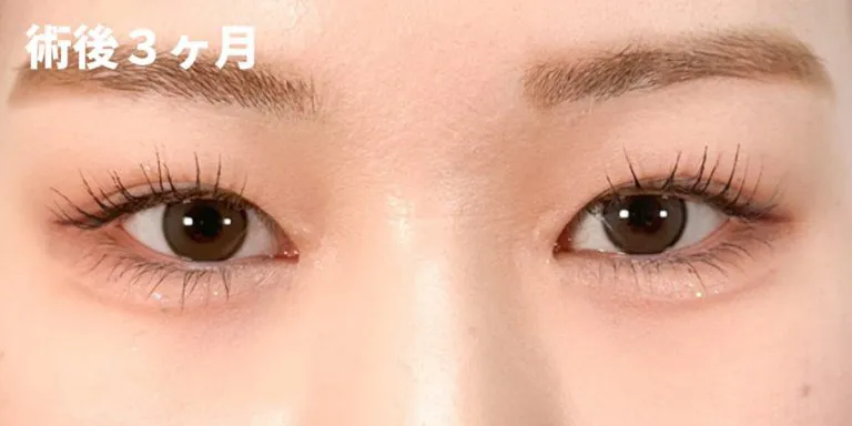 目頭切開経過写真