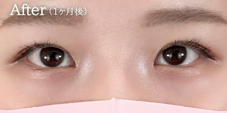 目頭切開経過写真