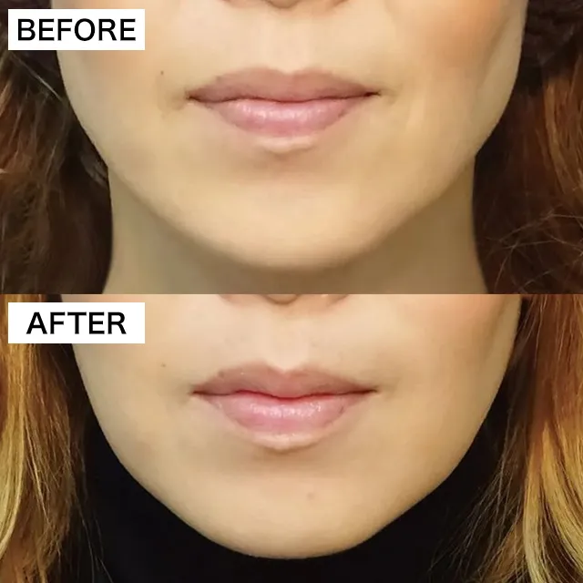 エラ小顔注射の症例写真