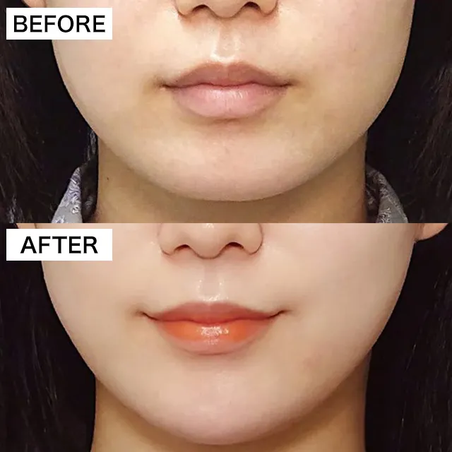 エラ小顔注射の症例写真