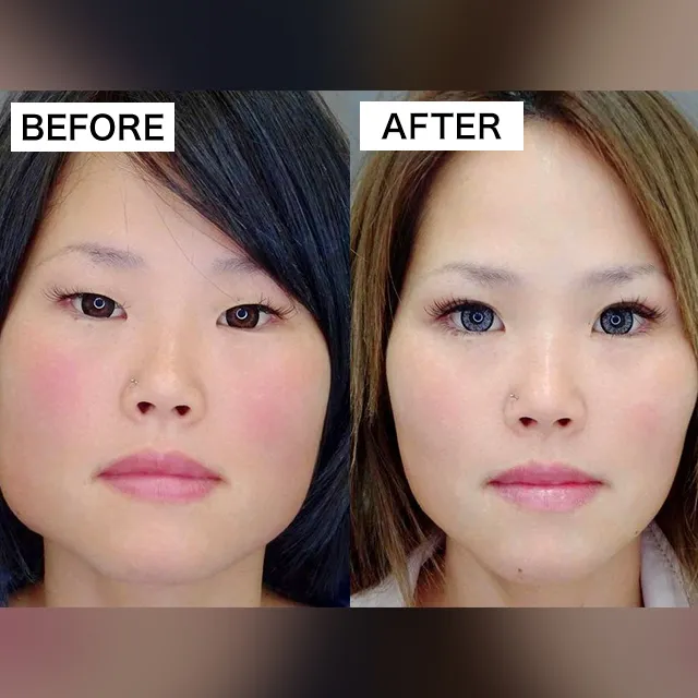 エラ小顔注射の症例写真