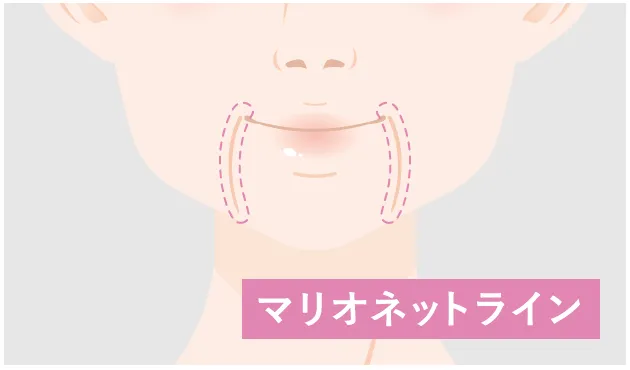 マリオネットラインを示すイラスト