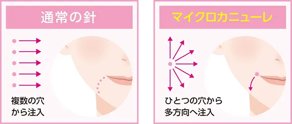 通常の針とマイクロカニューレの違い