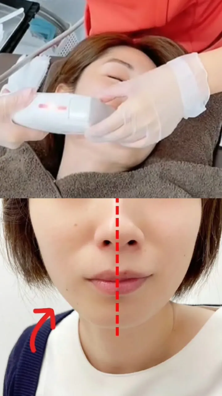医療ハイフの経過写真