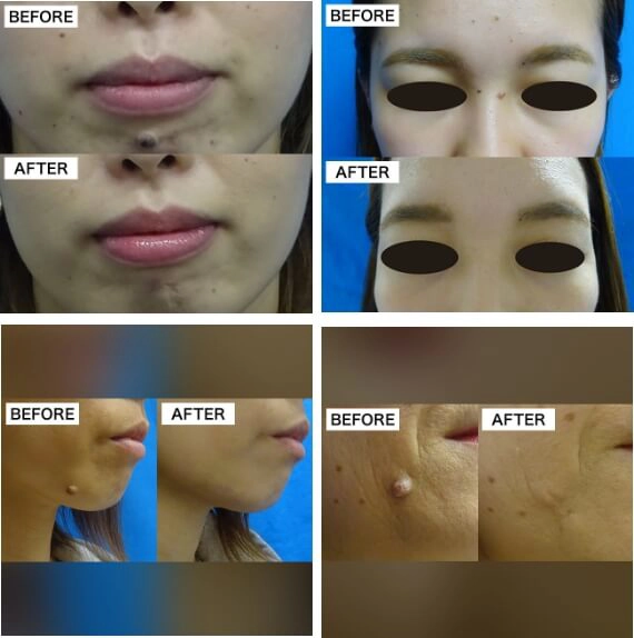 いぼ除去症例写真