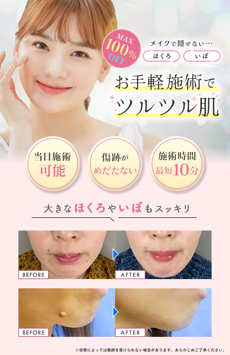 TCBのいぼ・ほくろ取り