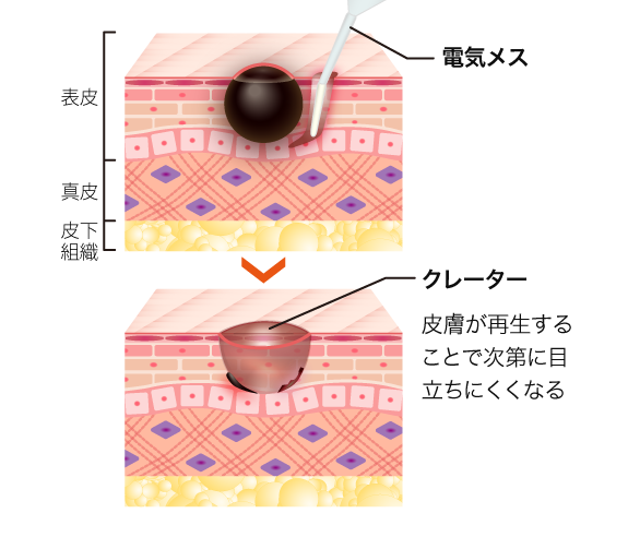 電気メスによる電気分解法
