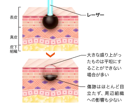 レーザー治療