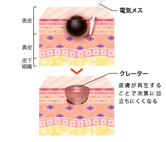 電気メスによる電気分解法