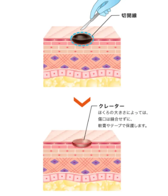 くり抜き法