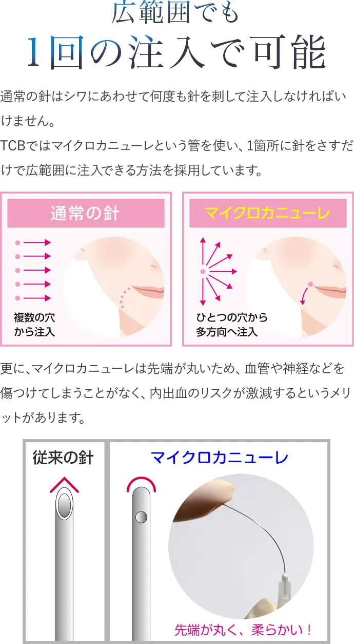 広範囲でも1回の注入で可能