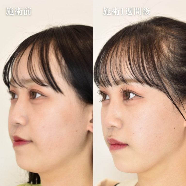 エラ（ボトックス注射）の症例写真4