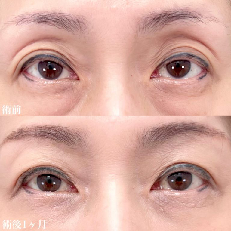 目の上のくぼみの症例写真1