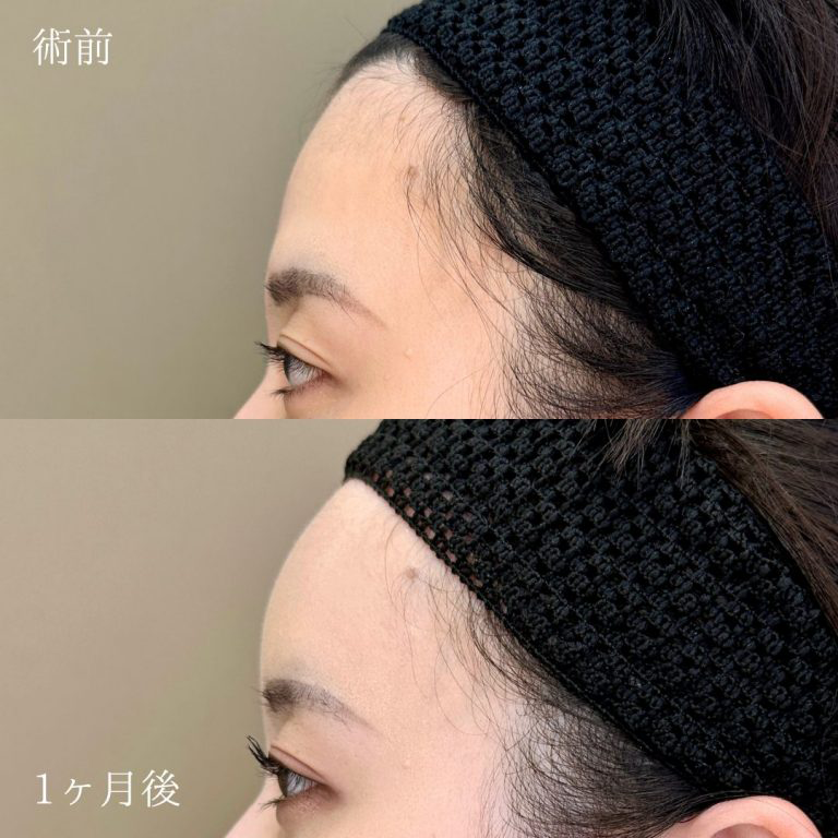おでこ・こめかみの症例写真1