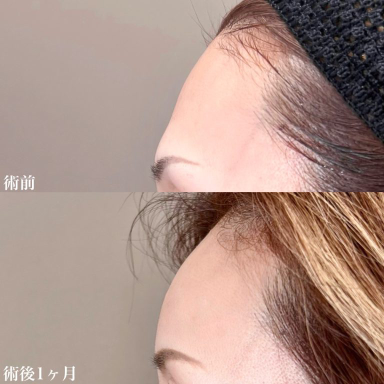 おでこ・こめかみの症例写真2