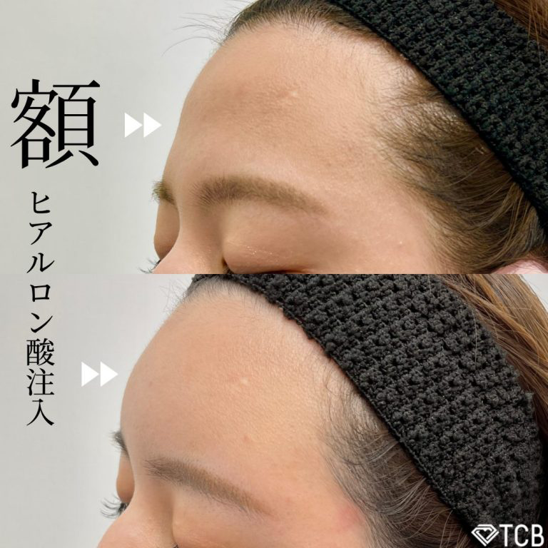 おでこ・こめかみの症例写真3