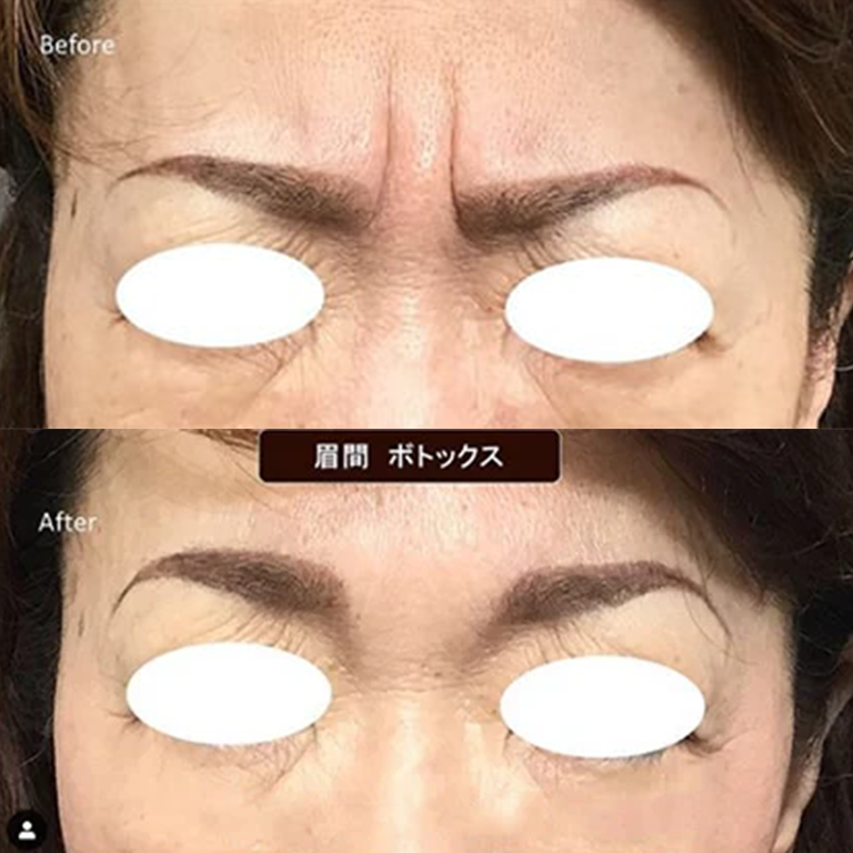 眉間のシワの症例写真1