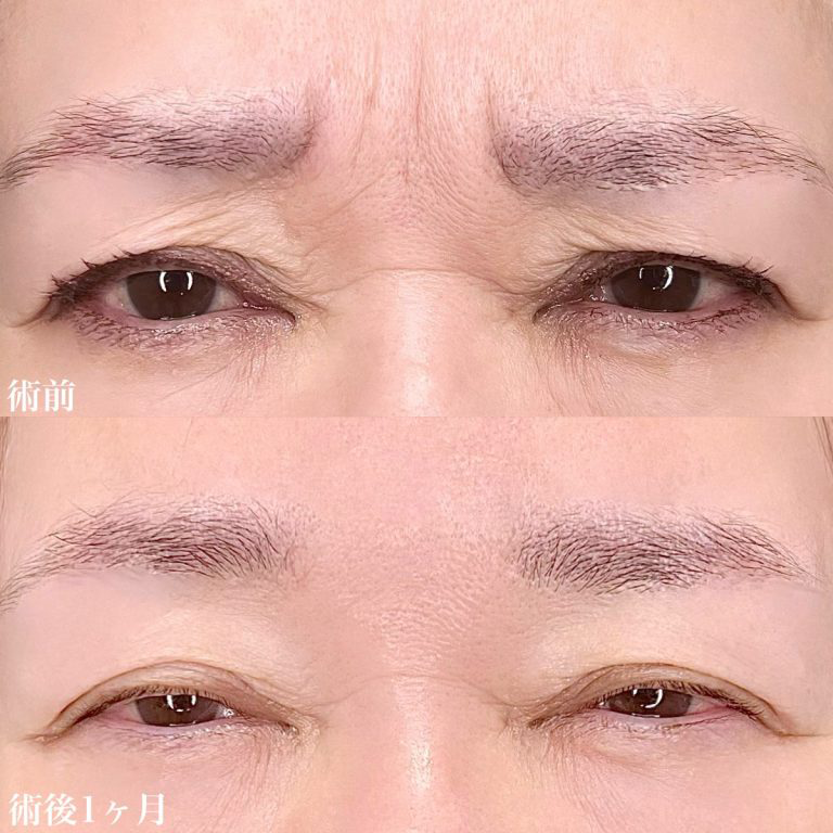 眉間のシワの症例写真2