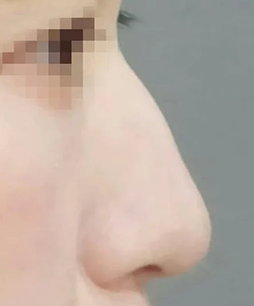 鼻の症例写真1