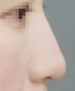 鼻の症例写真2