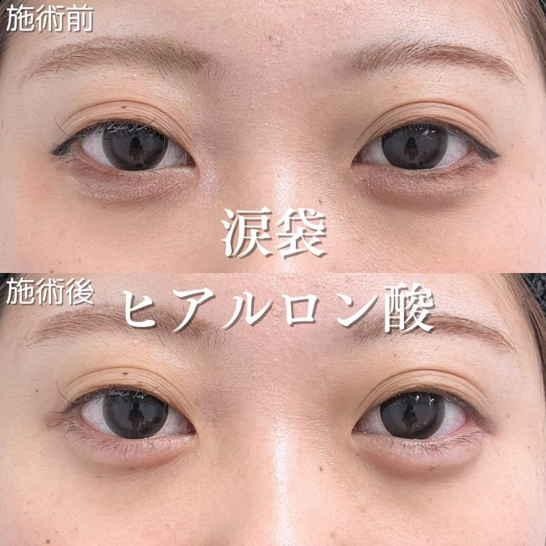 涙袋の症例写真1
