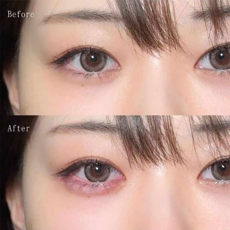 涙袋の症例写真3
