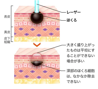 レーザー治療