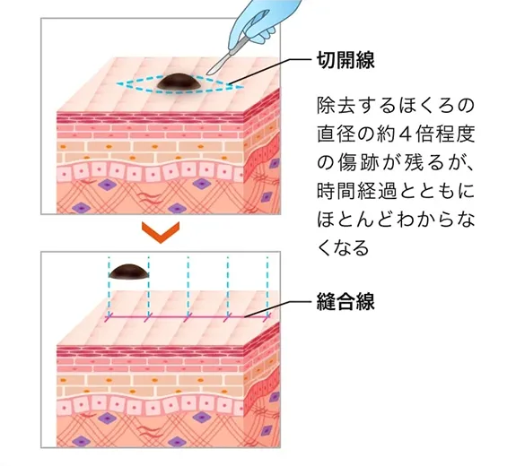 切開法