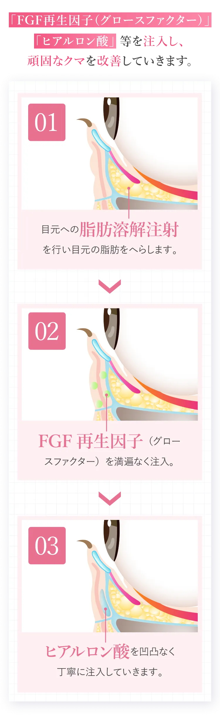 1回の注射で「FGF再生因子(グロースファクター)」、「ヒアルロン酸」等を注入し、頑固なクマを改善していきます。