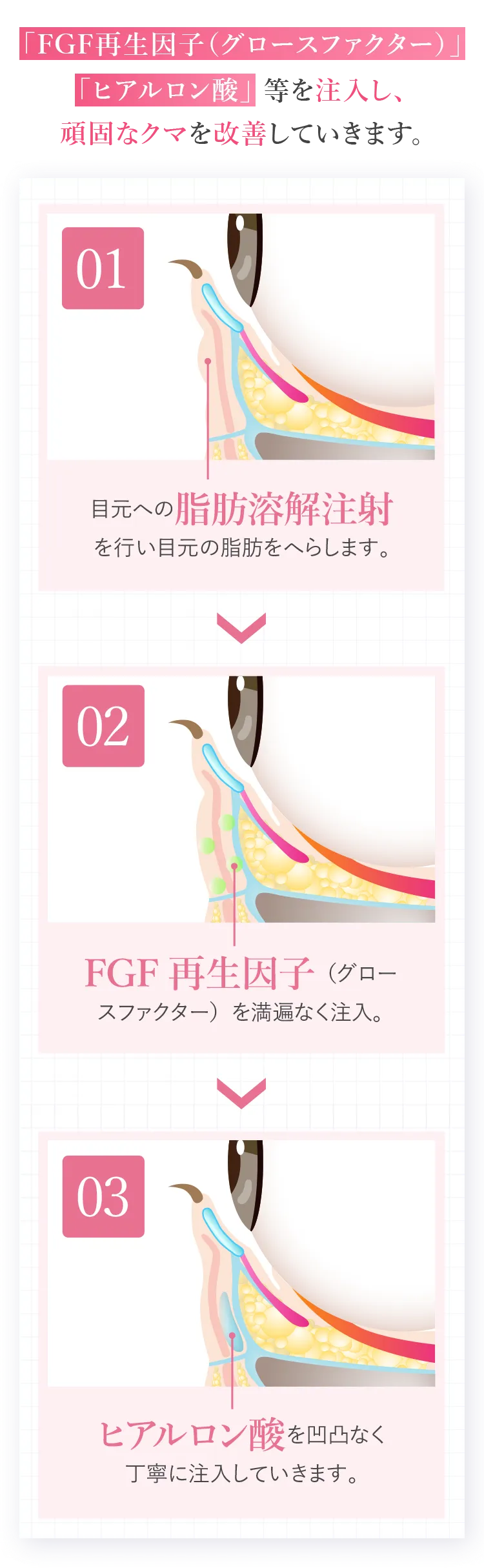 1回の注射で「FGF再生因子（グロースファクター）」、「ヒアルロン酸」等を注入し、頑固なクマを改善していきます。