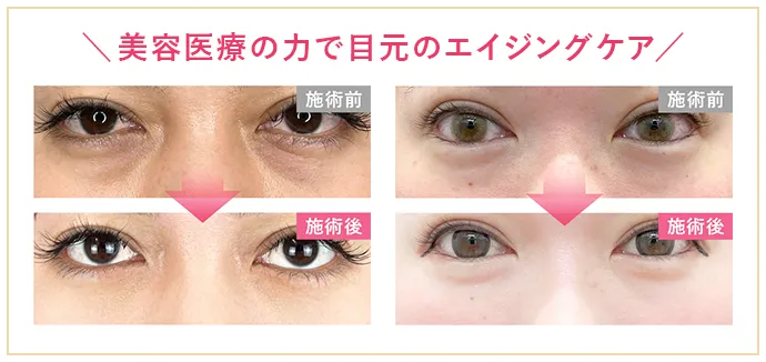 美容医療の力で目元のエイジングケア・症例写真
