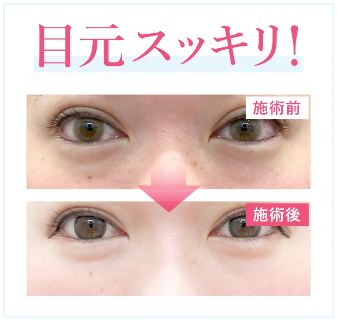 たった1回の施術で目元スッキリ！