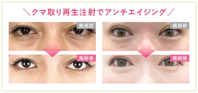 クマ取り再生注射でアンチエイジング・症例写真