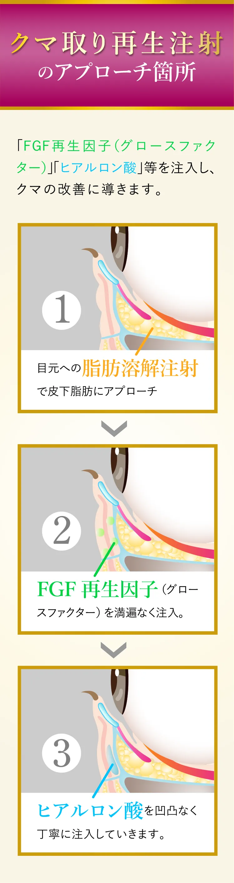 クマ取り再生注射のアプローチ箇所