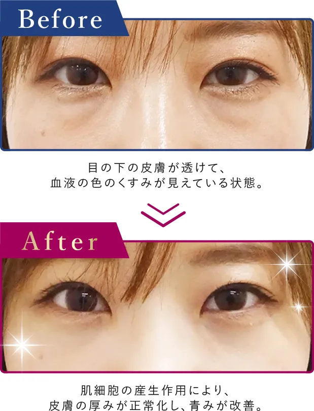 青クマの症例写真