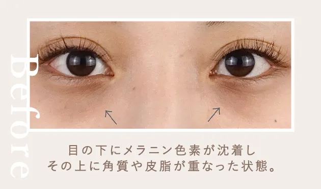 01茶クマ症例写真before