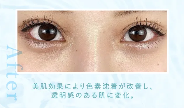 01茶クマ症例写真after