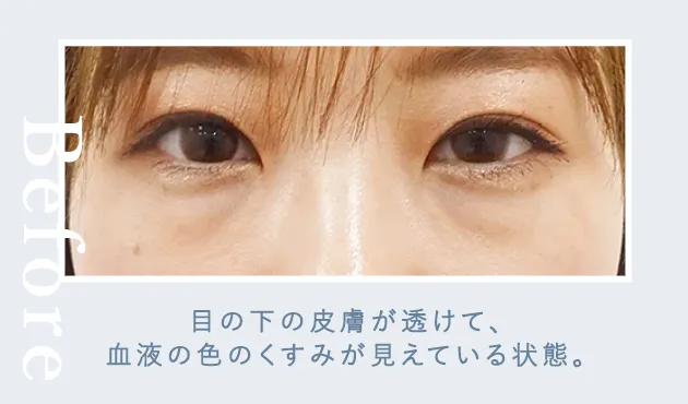 02青クマ症例写真before