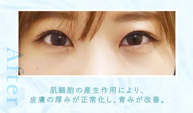 02青クマ症例写真after