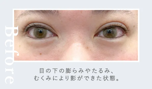 03黒クマ症例写真before