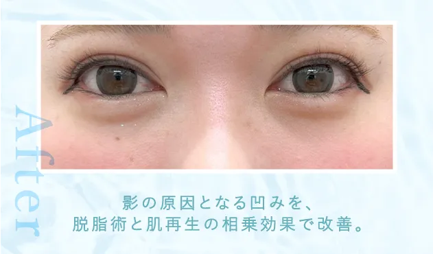 03黒クマ症例写真after