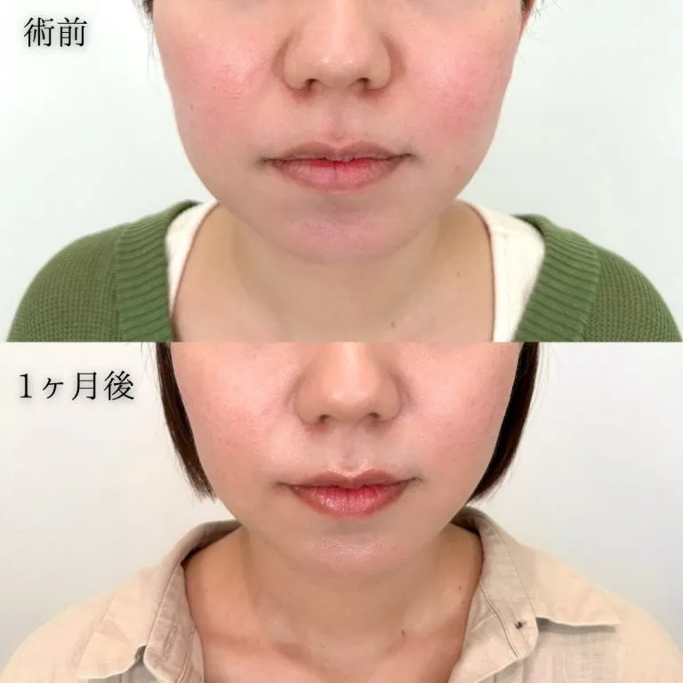 ハイフの症例写真