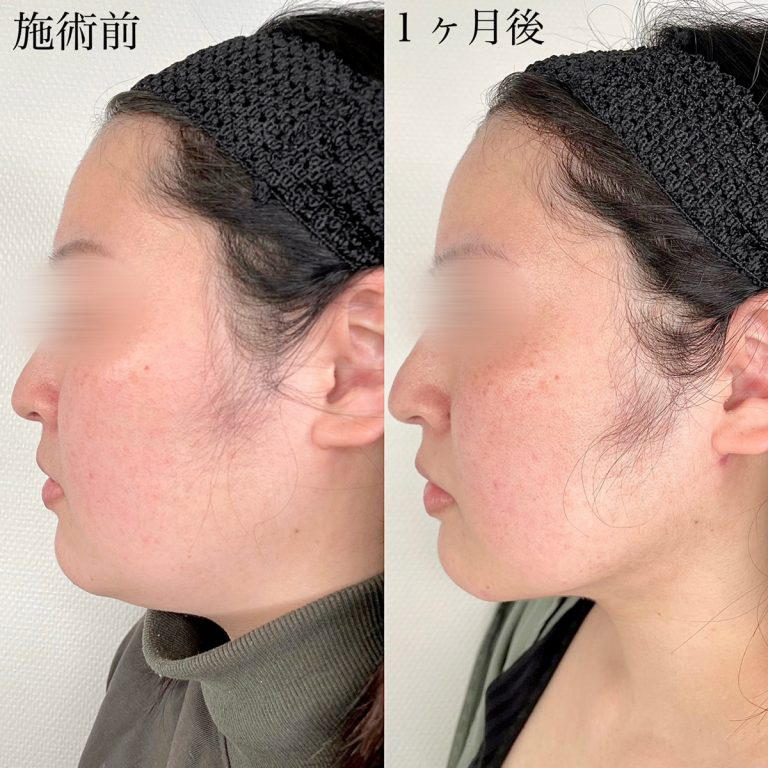 小顔の症例写真