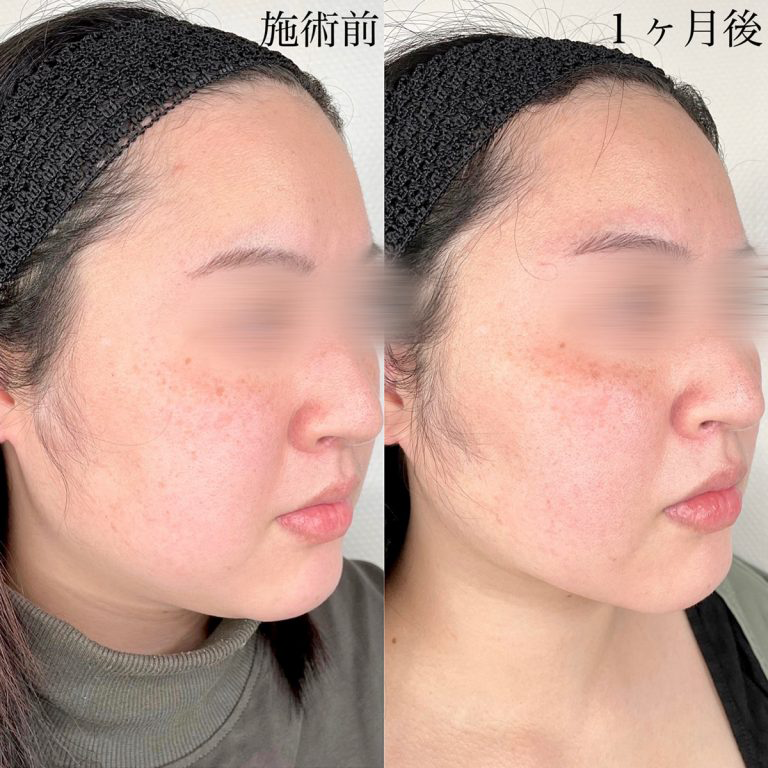 小顔の症例写真